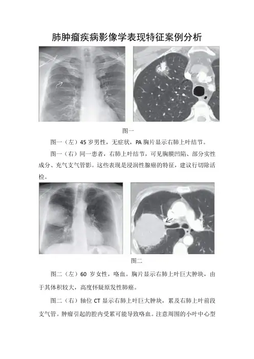 肺肿瘤疾病影像学表现特征案例分析