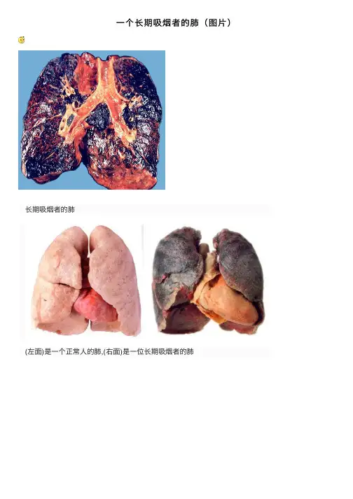 一个长期吸烟者的肺（图片）