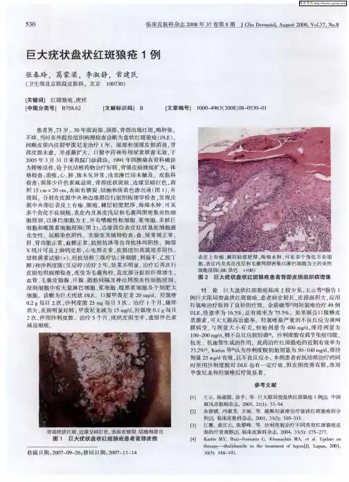 巨大疣状盘状红斑狼疮1例