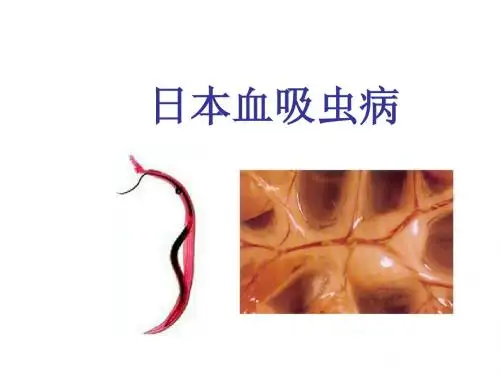日本血吸虫病(东毕血吸虫)Ok