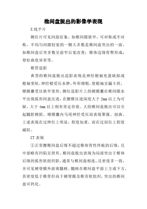 椎间盘脱出的影像学表现
