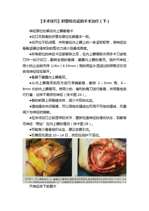 【手术技巧】肘管综合征的手术治疗（下）