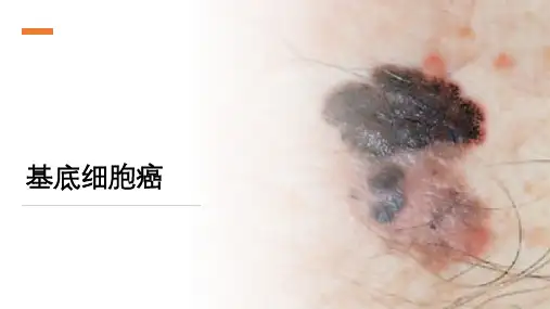 基底细胞癌