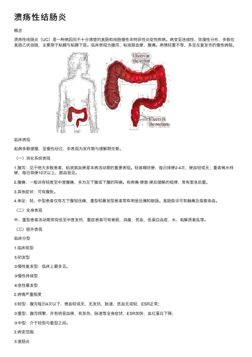 溃疡性结肠炎