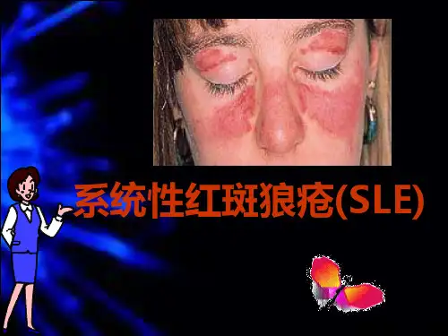 内科学--系统性红斑狼疮(SLE) PPT课件