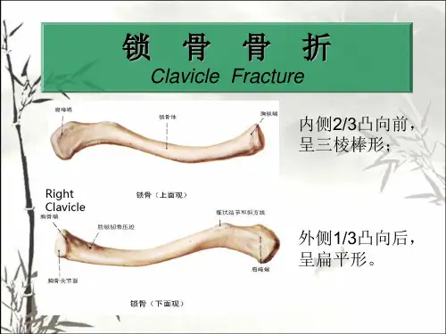 锁骨骨折幻灯片ppt课件