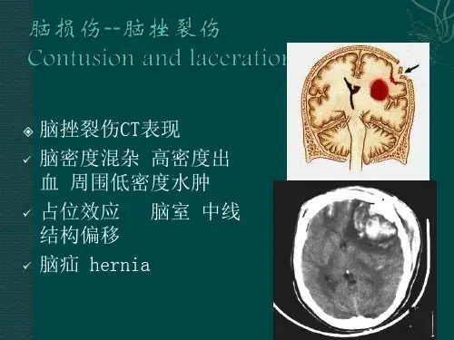 常见神经系统疾病影像学表现讲解
