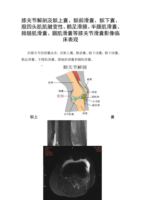 膝关节解剖及髌上囊、股四头肌肌腱变性、鹅足滑膜、半膜肌滑囊、腓肠肌滑囊等膝关节滑囊影像临床表现