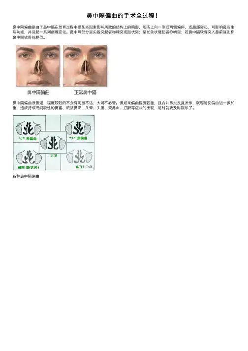 鼻中隔偏曲的手术全过程！
