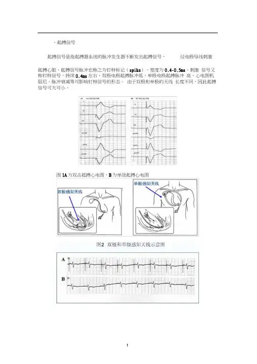 起搏心电图相关概念