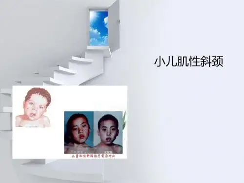 x小儿肌性斜颈