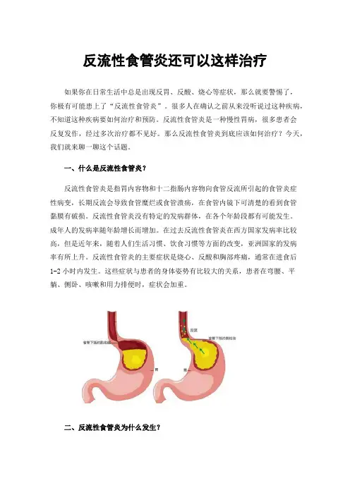 反流性食管炎还可以这样治疗