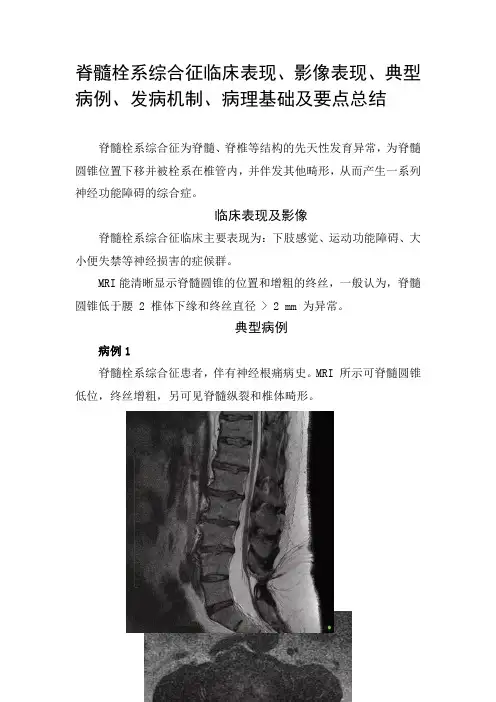 脊髓栓系综合征临床表现、影像表现、典型病例、发病机制、病理基础及要点总结