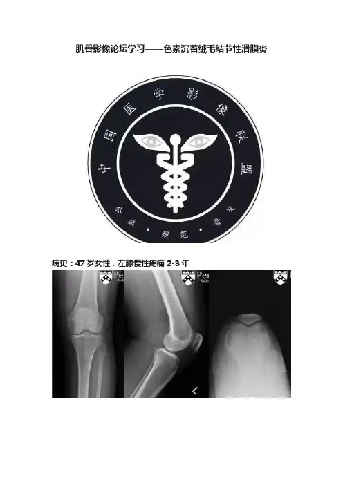 肌骨影像论坛学习——色素沉着绒毛结节性滑膜炎