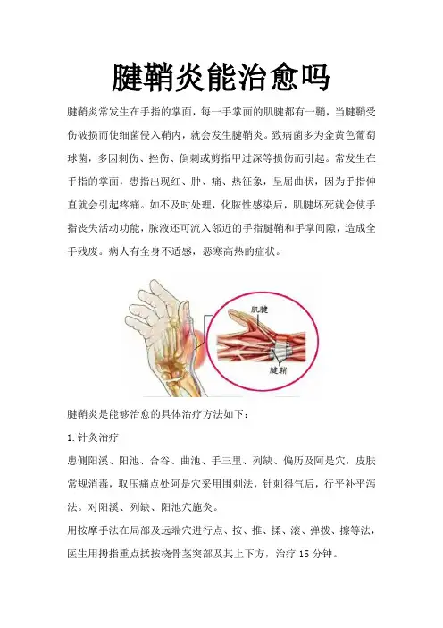 腱鞘炎能治愈吗