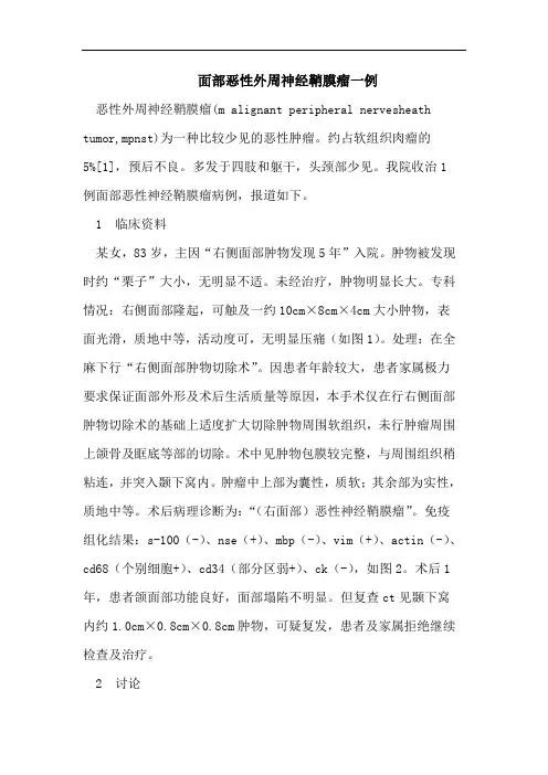 面部恶性外周神经鞘膜瘤一例