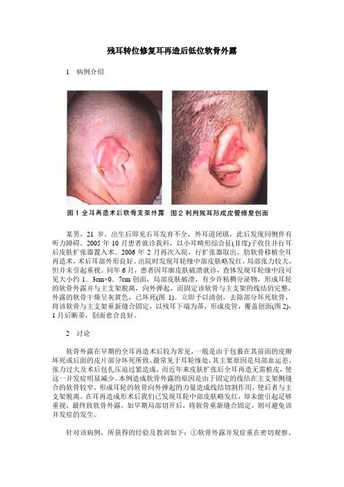 残耳转位修复耳再造后低位软骨外露