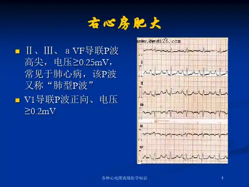 各种心电图表现医学知识培训课件