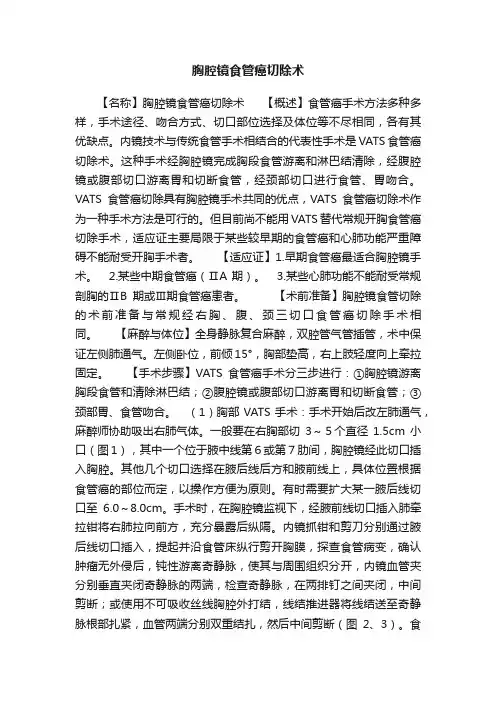 胸腔镜食管癌切除术