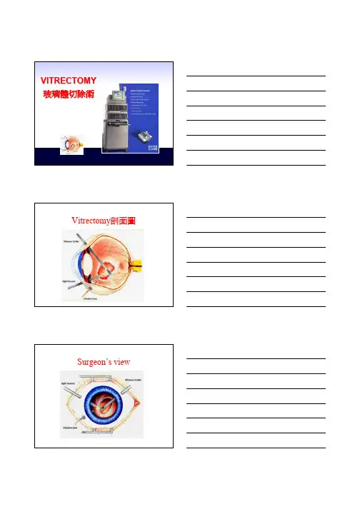 玻璃体切除术
