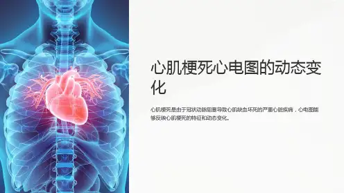 心肌梗死心电图的动态变化
