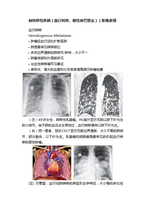肺转移性疾病（血行转移、癌性淋巴管炎）丨影像表现