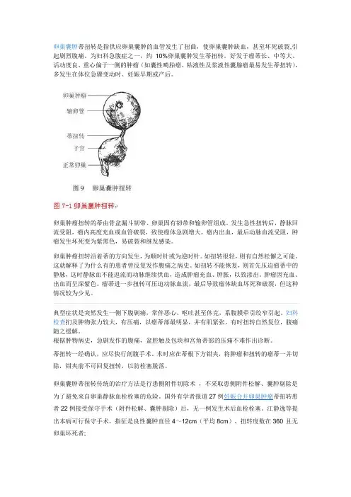 卵巢囊肿蒂扭转