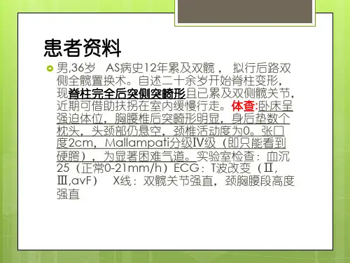 病例分析—强直性脊柱炎