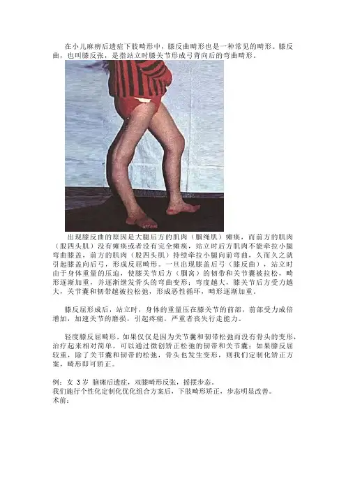 儿麻后遗症-膝反屈 膝反张(膝过伸)病因分析以及治疗方案