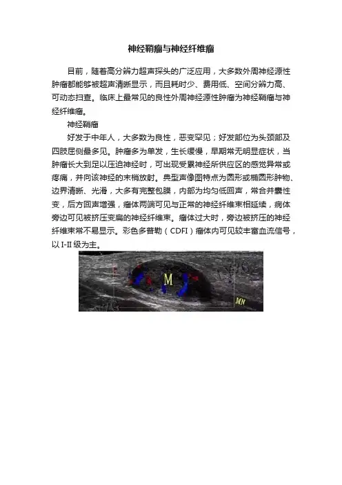 神经鞘瘤与神经纤维瘤