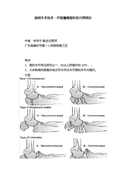 微创手术技术：尺骨鹰嘴骨折张力带固定
