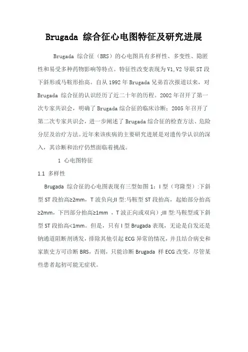 Brugada 综合征心电图特征及研究进展