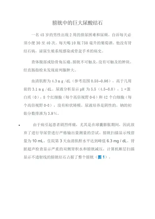 膀胱中的巨大尿酸结石