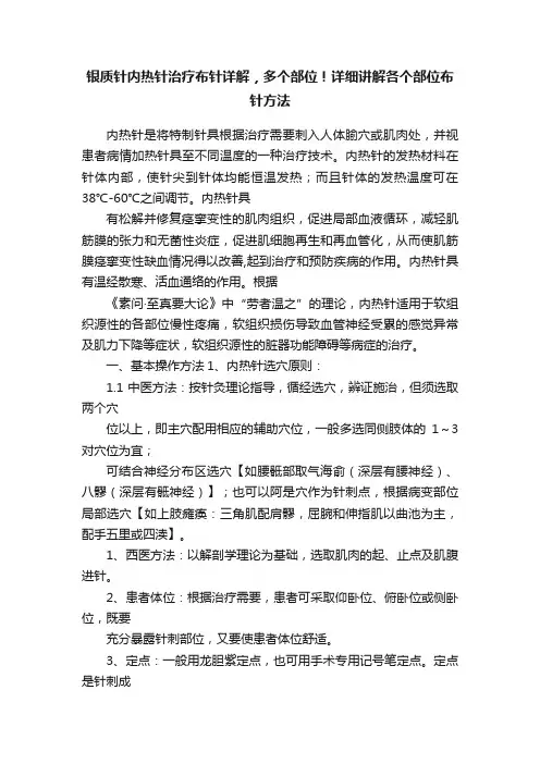 银质针内热针治疗布针详解，多个部位！详细讲解各个部位布针方法
