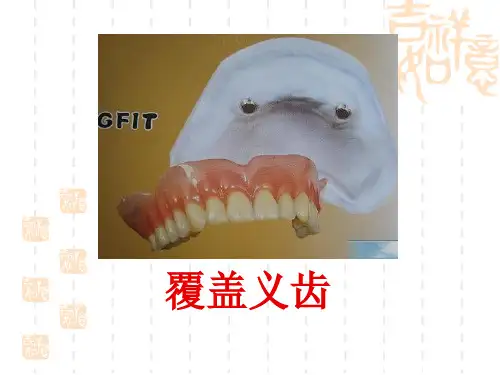 覆盖义齿