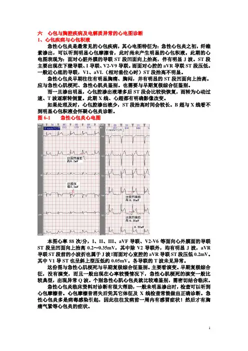 另类心电图讲义-14--心包胸膜炎电解质异常