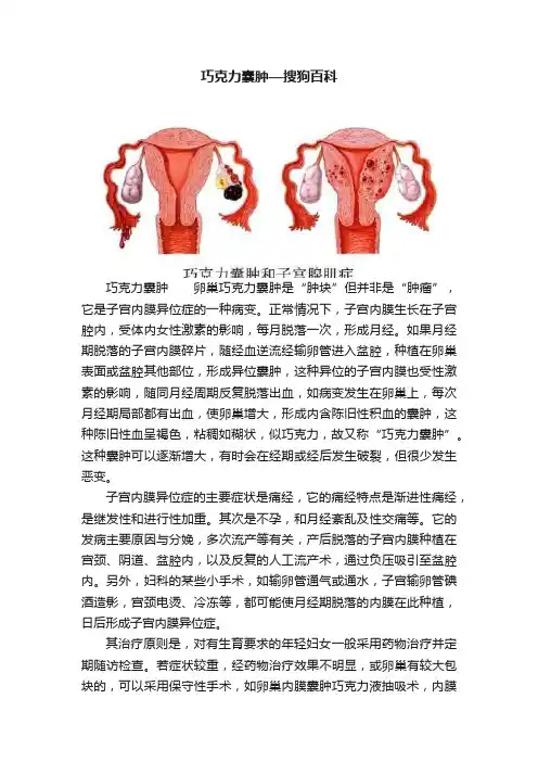 巧克力囊肿—搜狗百科