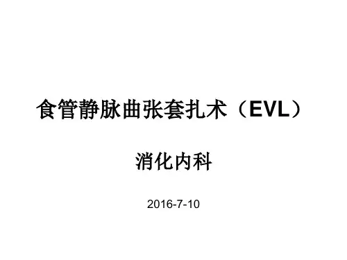 食管静脉曲张套扎术
