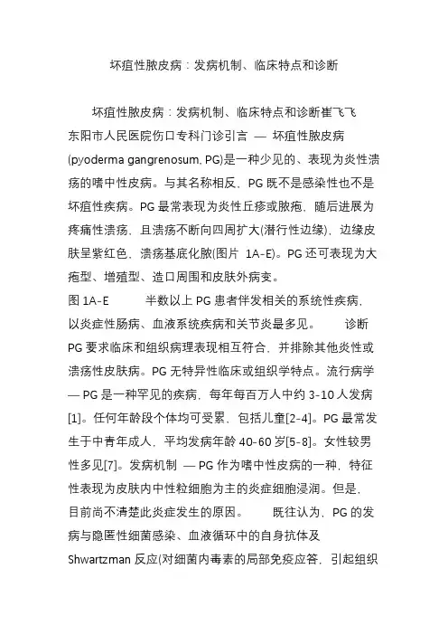 坏疽性脓皮病：发病机制、临床特点和诊断
