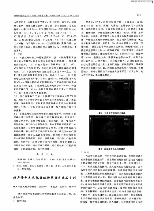 超声诊断先天性巨结肠并巨大粪石1例