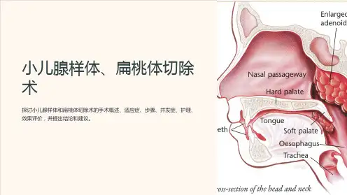 小儿腺样体、扁桃体切除术