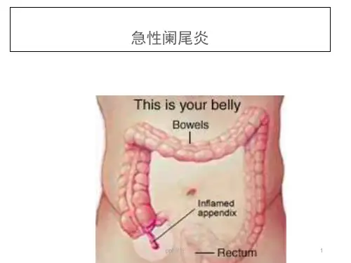 急性阑尾炎患者的护理  ppt课件
