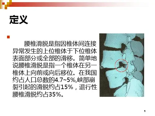 腰椎滑脱ppt课件