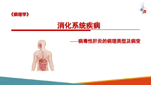 病毒性肝炎—病毒性肝炎类型(病理学课件)