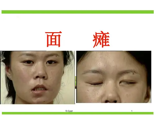 中医面瘫完整ppt课件