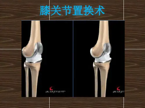 膝关节置换讲解
