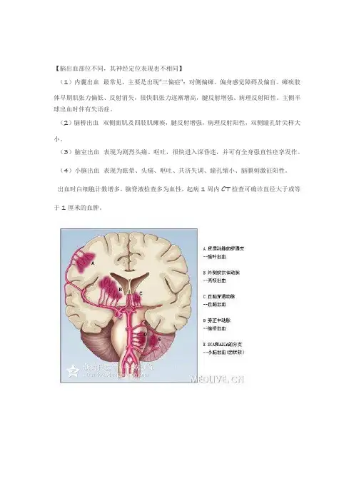 脑出血的神经定位