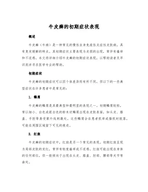 牛皮癣的初期症状表现
