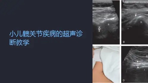 小儿髋关节疾病的超声诊断教学