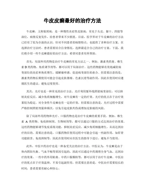 牛皮皮癣最好的治疗方法